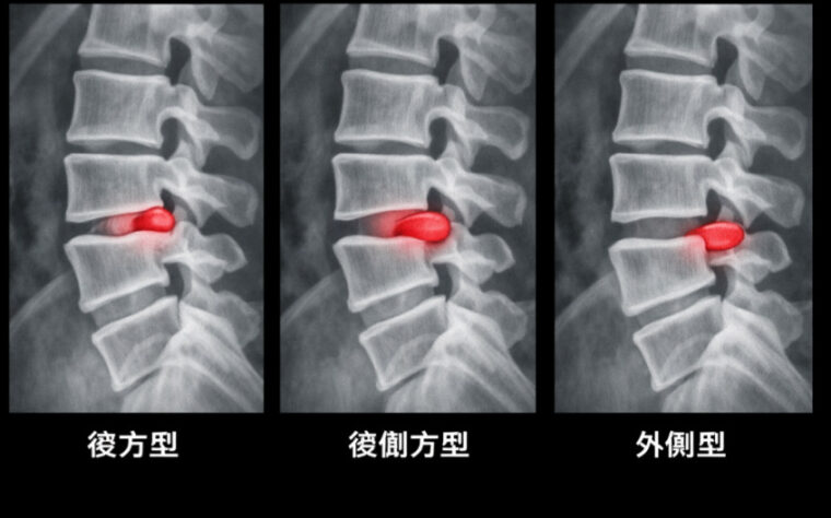『腰椎椎間板ヘルニアには種類があります』