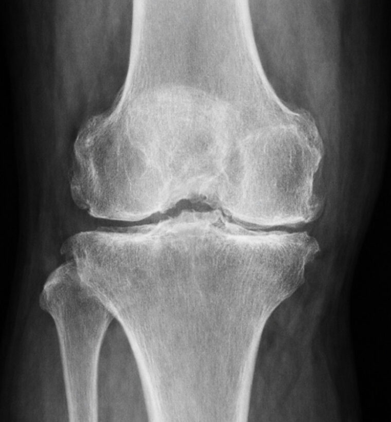 『変形性膝関節症の痛みの原因』