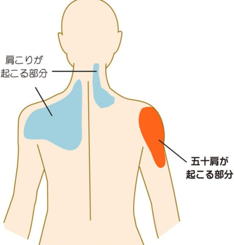 『肩こりと五十肩は違うの？』